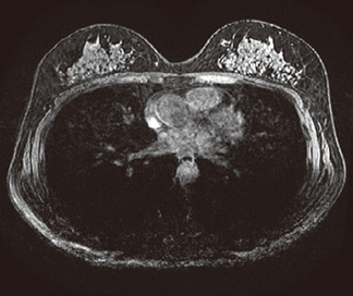 無痛乳房MRI